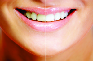 teeth-whitening-results2.jpg