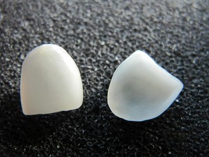 veneer(1).jpg