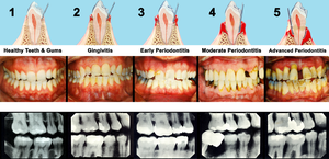GUMDISEASE.png