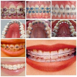 1268163518_79467966_1-Pune-Orthodontics-Braces-for-your-confidence-Orthodontic-S