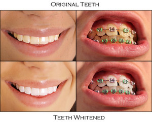 before-and-after-teeth-panel.jpg